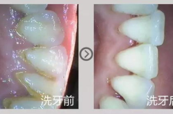 洗牙后怎么保洁牙齿最有效,洗牙后保洁牙齿的黄金法则