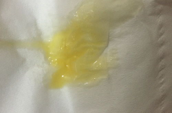 鼻涕黄色粘稠是什么原因,解析鼻涕黄色粘稠背后的健康信号